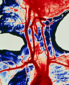 Coloured angiogram of carotid arteries
