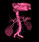 Angiogram of Abdominal Aorta