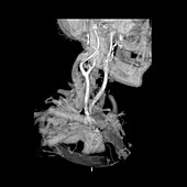 3D CTA of Carotid Arteries