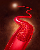 Illustration of a blood clot
