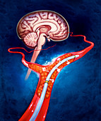 Illustration of brain blood clot therapy