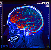Brain,X-Ray,& EEGS