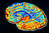 Computer-enhanced image through cerebrum of brain