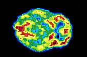PET scan of a normal human brain