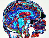 False-colour MRI image of brain of 80-year-old man