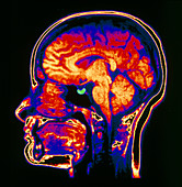 MRI scan of brain with pituitary gland highlighted