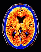 CT scan of section through healthy brain