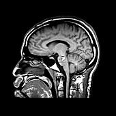 Sagital Cross Sectional MRI of the Brain
