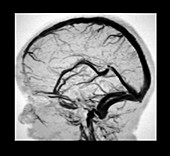 Intracranial Magnetic Resonance Venogram