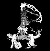 3D Angiogram of Intracranial Vein