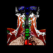 Coronal MRI of Brachial Plexus