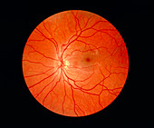 Ophthalmoscope image of a normal retina