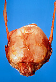 Gross specimen of normal human bladder & ureters