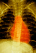 Heart and lungs,X-ray