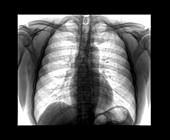 Normal Chest X-ray