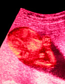 Coloured ultrasound scan of foetus aged 28 weeks
