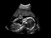Normal Pre-natal Ultrasound