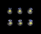 Nuclear Medicine Scan of Thyroid Gland