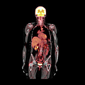 Whole Body Scan for Metastatic Disease