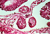 LM of Balantidium coli parasitic in the intestine