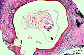 LM of Taenia solium cysticercus in human brain