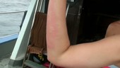 Jellyfish sting on woman's arm
