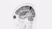 Brain atrophy, 3D MRI scan