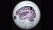 Brain atrophy, 3D MRI scan