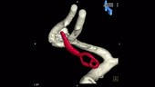 Brain aneurysm repair, 3D CT scan