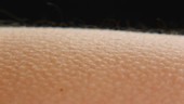 Goosebumps on skin