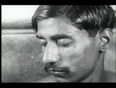 Leprosy in India, 1930s