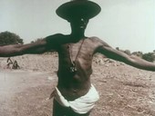 Onchocerciasis symptoms, 1960s Ghana