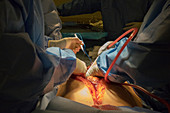 Bowel surgery in cirrhosis
