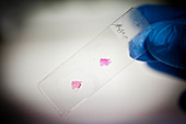 Test staining of cancer biopsy tissue
