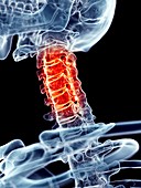 Human cervical spine pain