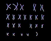 Turner's syndrome karyotype,illustration