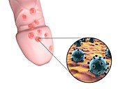 Herpes virus and lesions,illustration