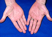 Hands of person suffering from xanthaemia