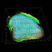 Breast cancer, 3D tomography