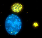 Colorectal cancer, genomic amplification