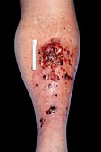 Metastatic melanoma on a leg