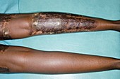 Granulomatosis with polyangiitis