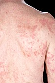 Psoriasis