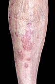 Psoriasis