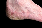 Psoriasis