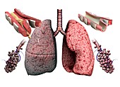 Chronic obstructive pulmonary disease, illustration