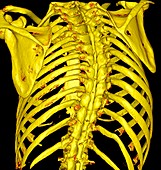 Scoliosis, 3D CT scan