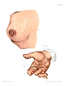 Syphilis chancres, illustration