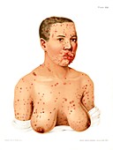 Secondary syphilis, illustration