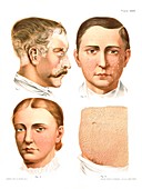 Skin disorders, historical illustration